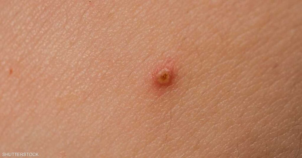 "علامات بسيطة" على بشرتك قد تشير إلى الإصابة بالسرطان