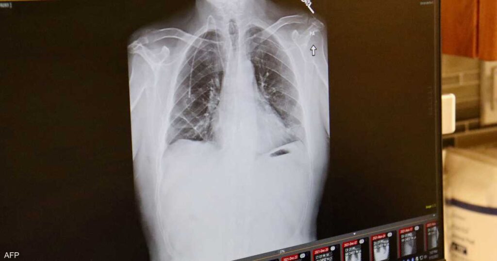 علماء يكشفون سر انتشار سرطان الرئة لدى غير المدخنين